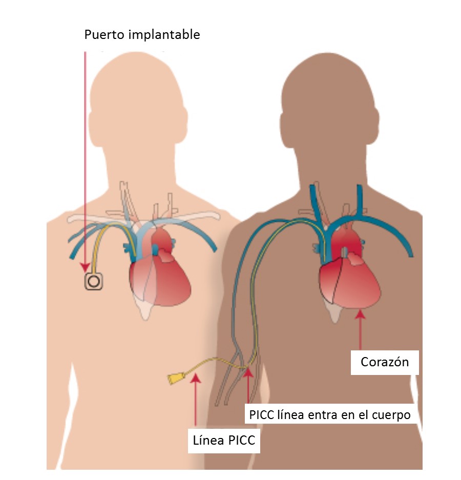 Diagram of different types of catheters/implantable ports