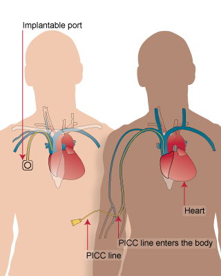 Diagram of different types of catheters/implantable ports