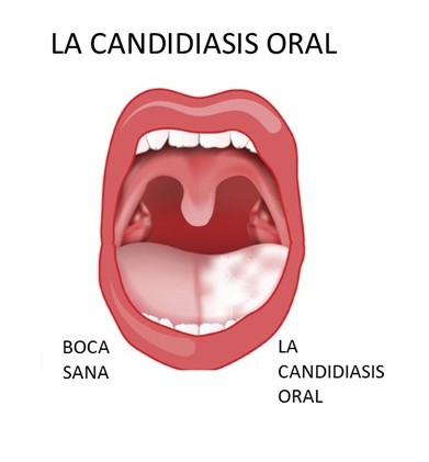 Diagram of the mouth showing the tonsils, hard and soft palates, uvula, tongue, gingiva, and vestibule.